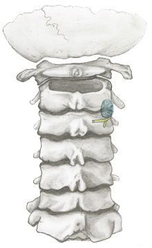 Cervical Radiofrequency Ablation (RFA)