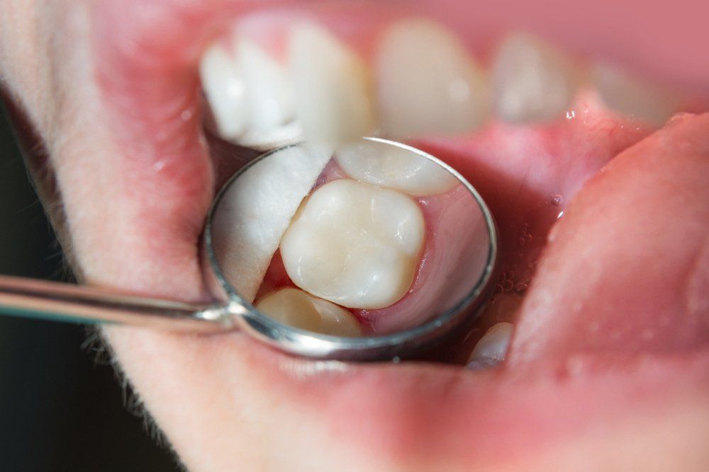 Dentist Looking At Cavities — Island Sands Dental in Boyne Island, QLD