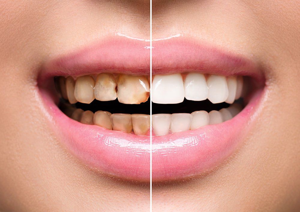 Before And After Teeth Clean — Island Sands Dental in Boyne Island, QLD
