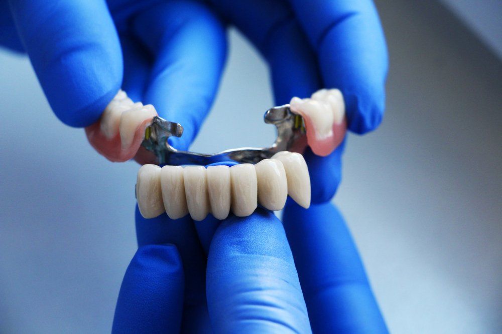 Implant Supported Bridge — Island Sands Dental in Boyne Island, QLD