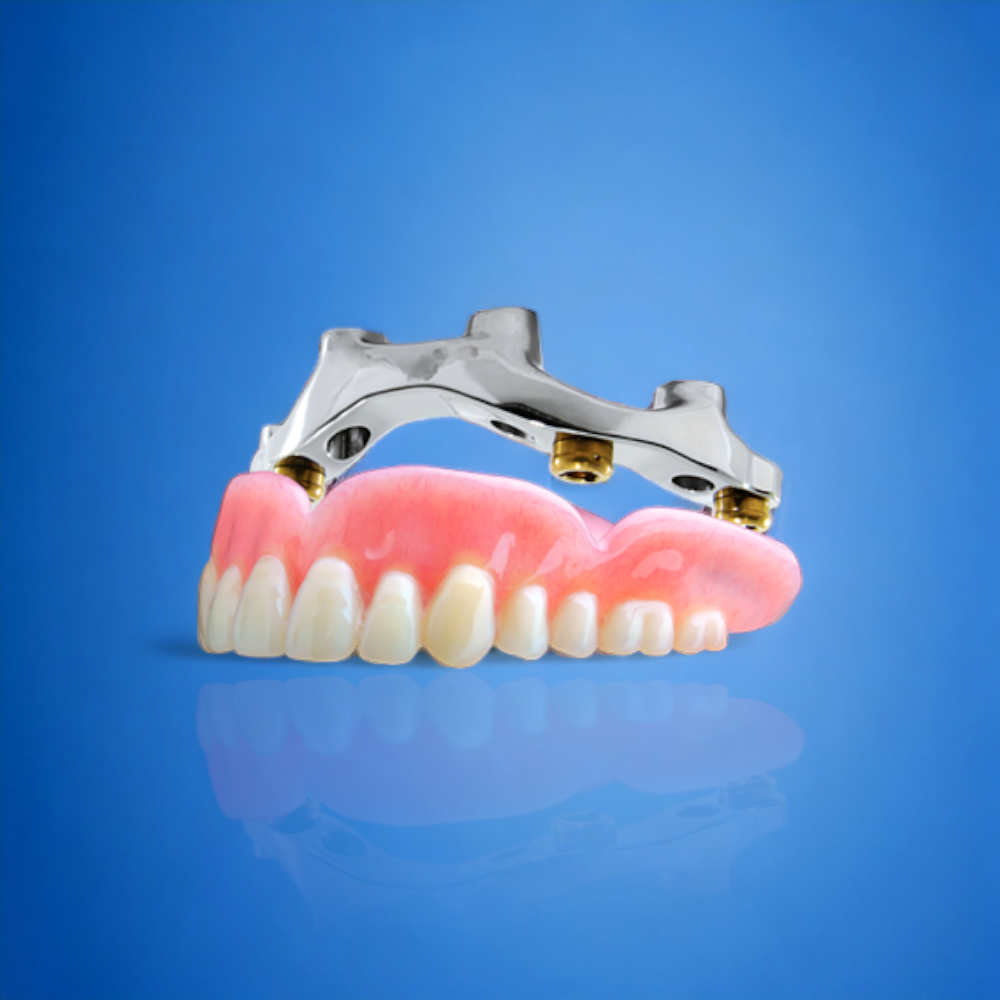 Locator Bar Locator Bar Overdentures | Bar-Supported Implant Prosthetics