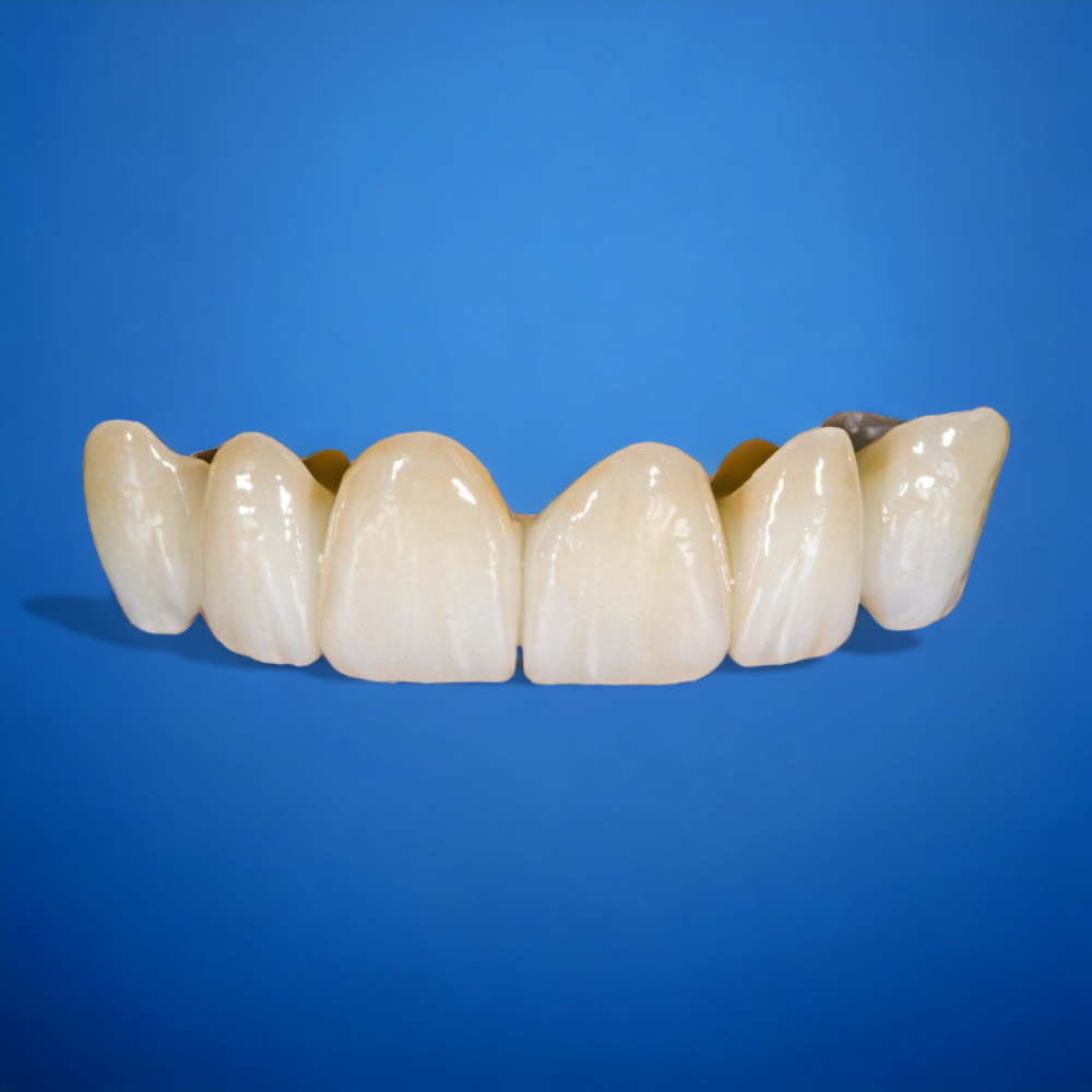 Multi Layer Zirconia Crowns Layered CAD CAM Fabrication