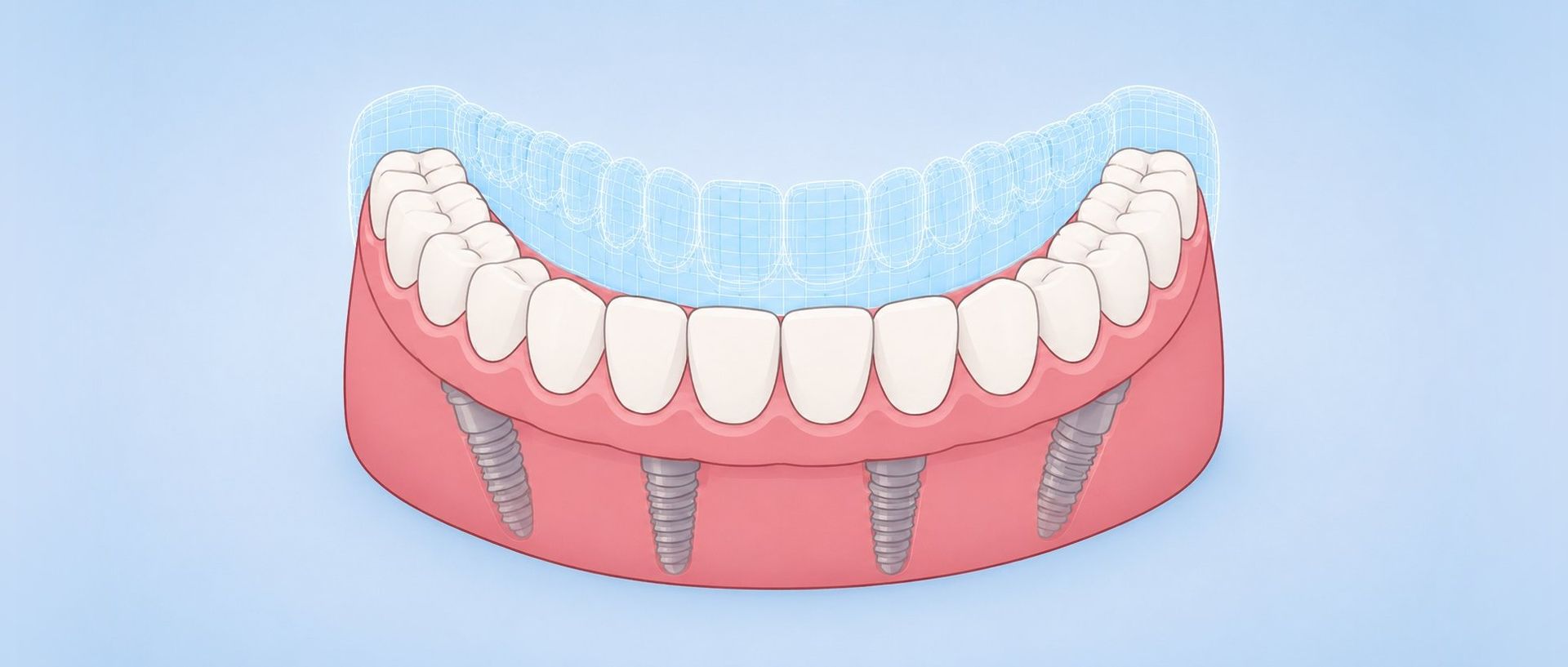 Stylized full-arch implant prosthesis with its digital treatment plan, illustrating the workflow