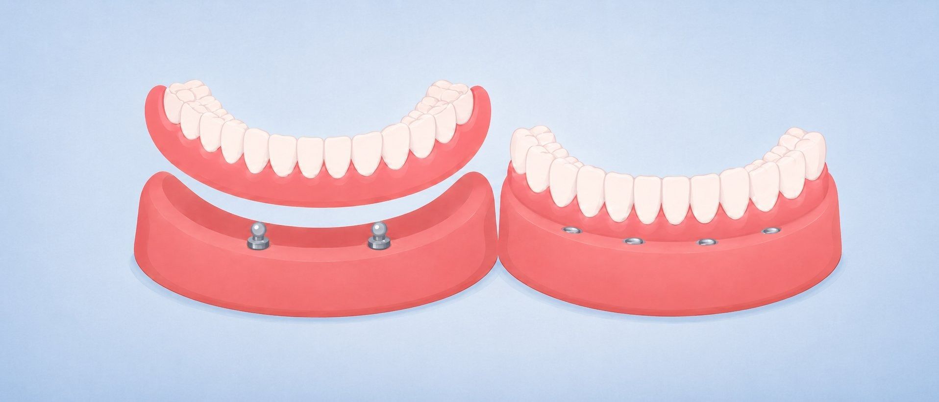 Illustration comparing an implant-supported overdenture and a fixed full-arch prosthesis