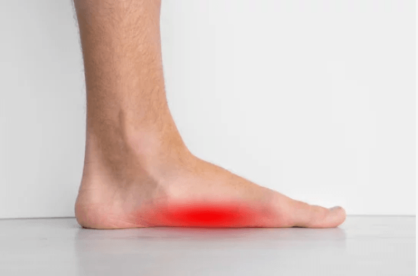 Flat Feet & High Arches - Cure Podiatry & Wound Care