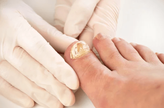 Athlete's Foot & Toenail Fungus - Cure Podiatry & Wound Care