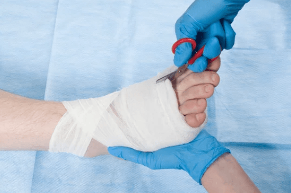 Extensive Wound Care - Cure Podiatry & Wound Care