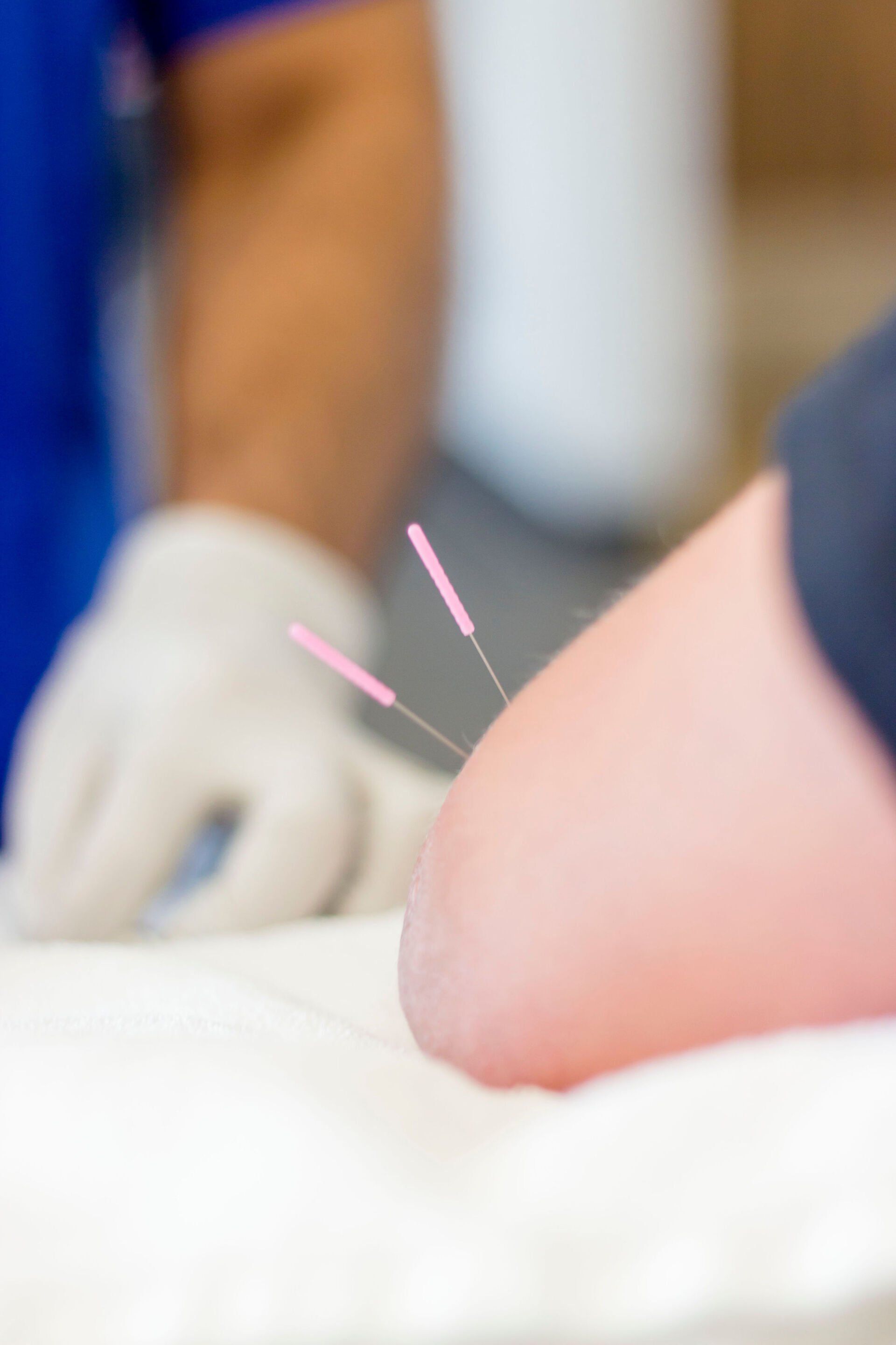 Acupuncture needles inserted into a person’s back during a treatment session