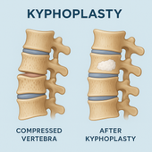 Diagram showing a compressed vertebra before and after a kyphoplasty procedure.