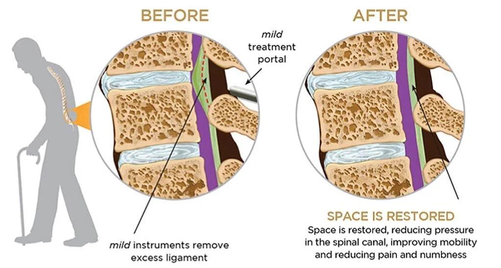 Diagram of spine: before and after surgery. It shows a man with a stooped posture before and straightened after spinal treatment.