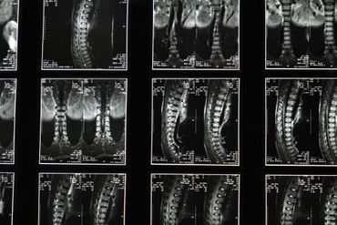 Medical images of a human spine. Series of black and white MRI scans.