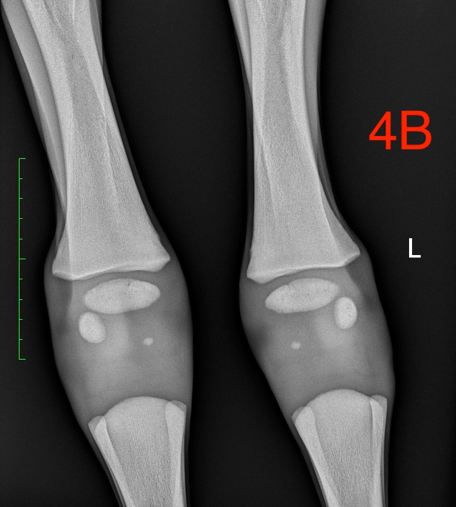 figuur 4B een radiografische opname van een onvolledige verbening van de beentjes van de voorknie door een te vroeggeboorte onvolledige verbening van de beentjes van de voorknie corpus door een te vroeggeboorte