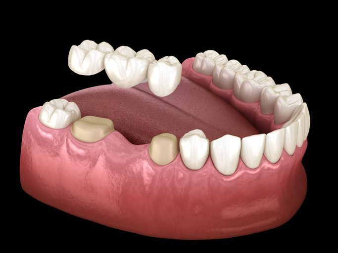 Dental bridge model over lower teeth, showing missing tooth replacement.