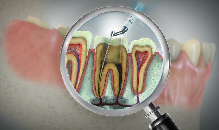 Cross-section tooth illustration, magnified to show root canal procedure with instruments.