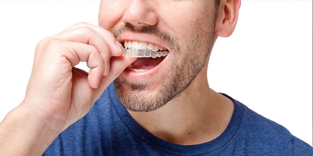 Man inserting a clear dental aligner into his mouth. He is wearing a blue shirt.