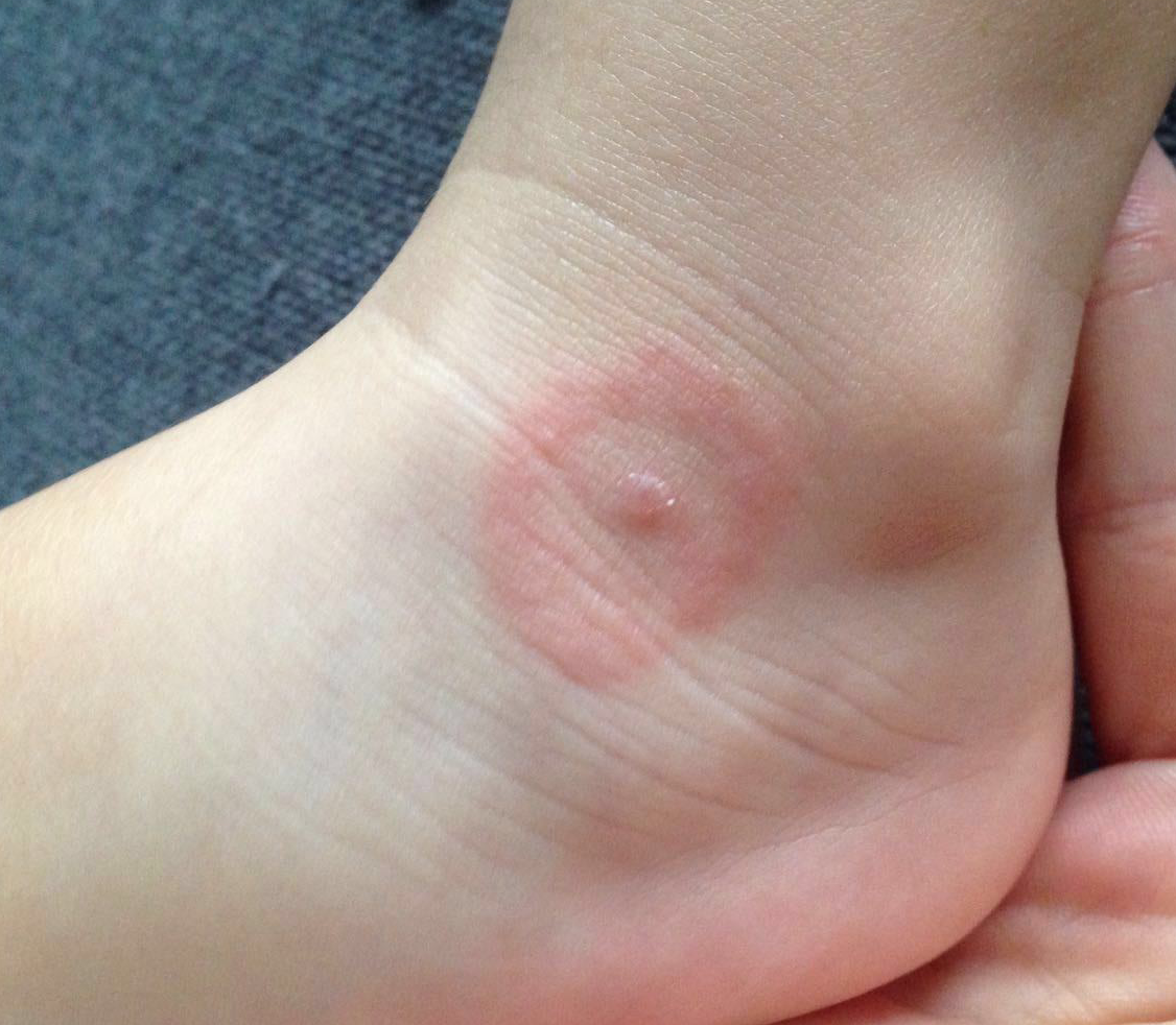 Diagnostik von Borrelien & Co-Infektionen