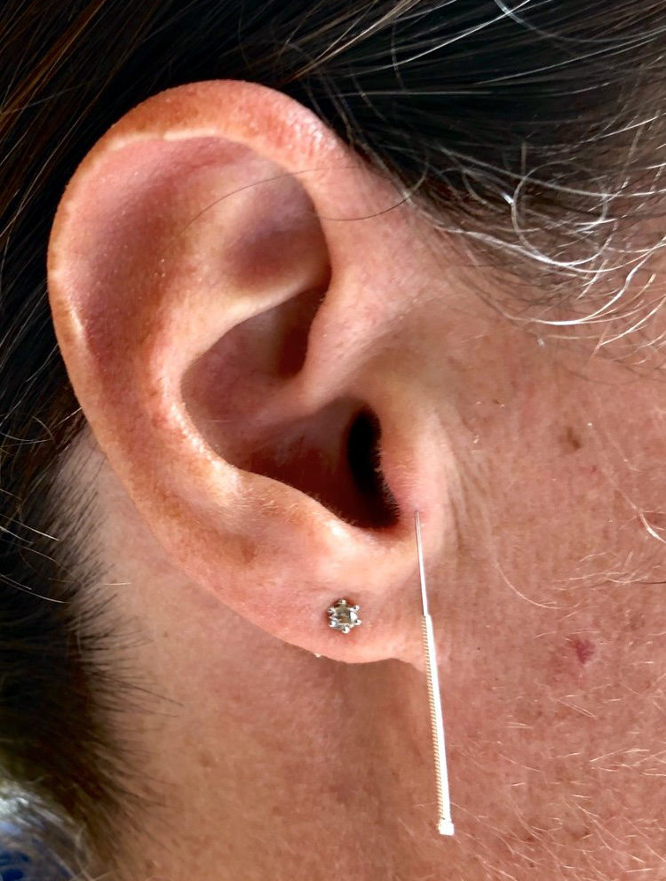 Acupuncture