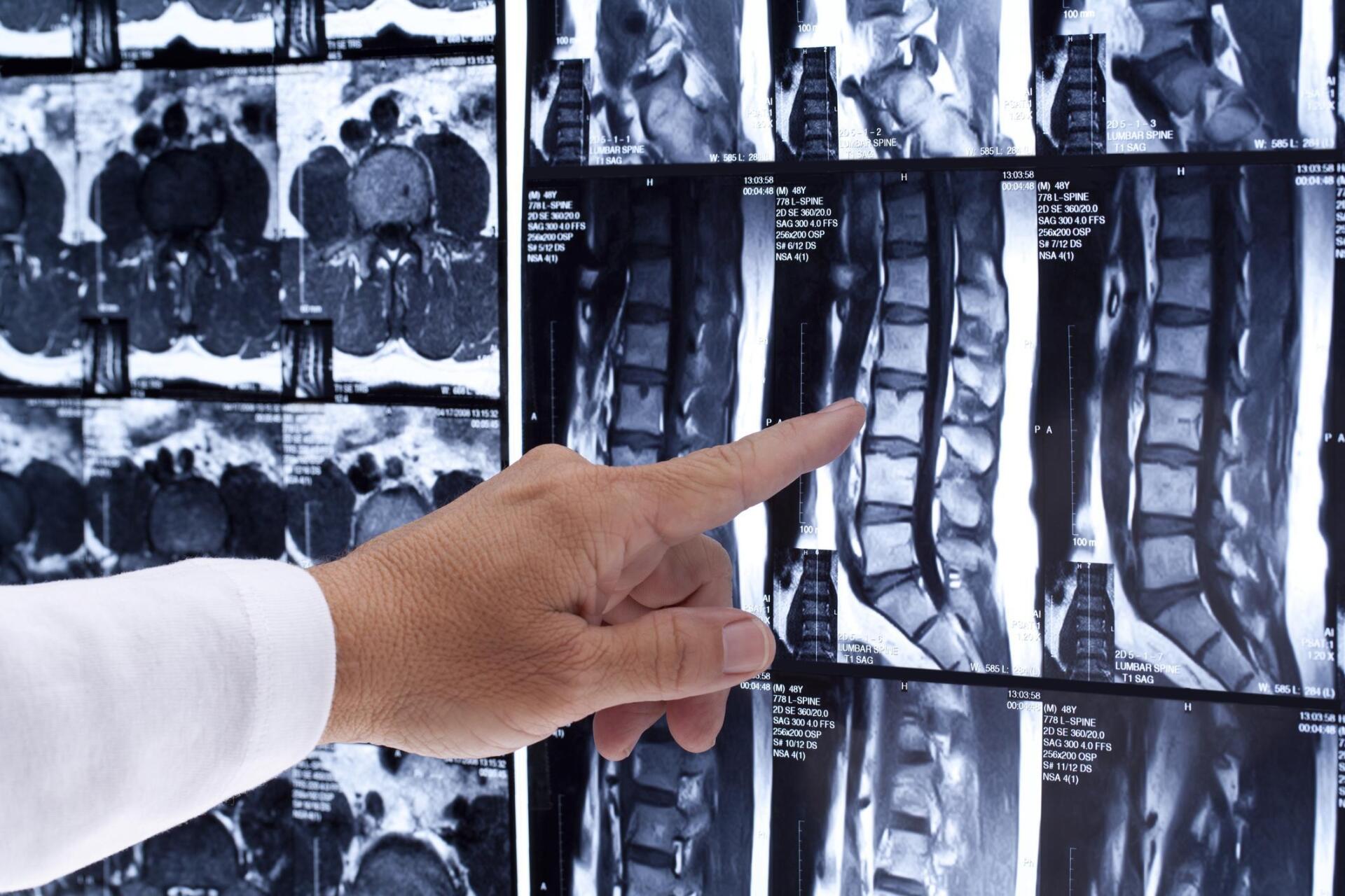Doctor pointing at spinal MRI scans.