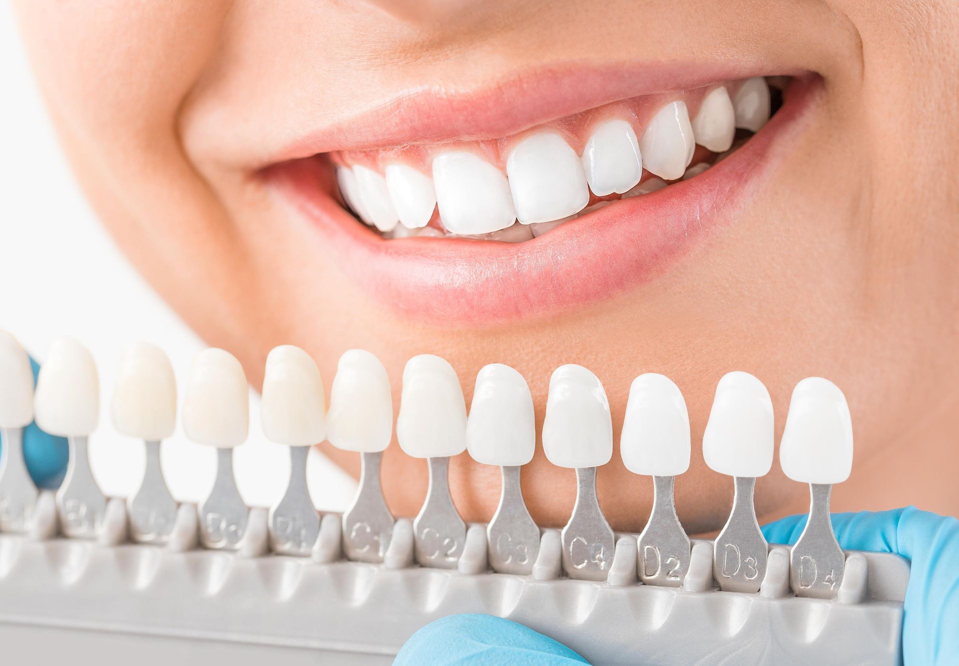 A close up of a woman 's teeth with a tooth color chart.