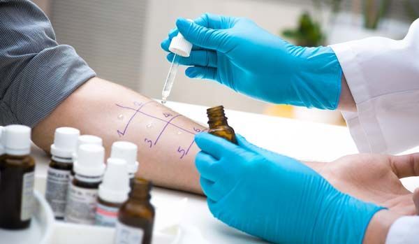 Gloved clinician collecting skin allergy test sample from arm with marked test spots