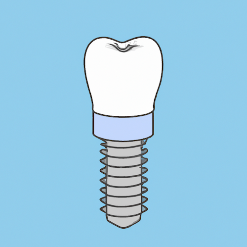 A tooth with a screw attached to it on a blue background.
