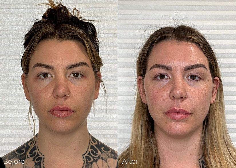 A before and after photo of a woman 's face.