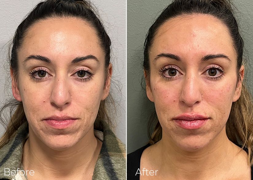 A before and after photo of a woman 's face.