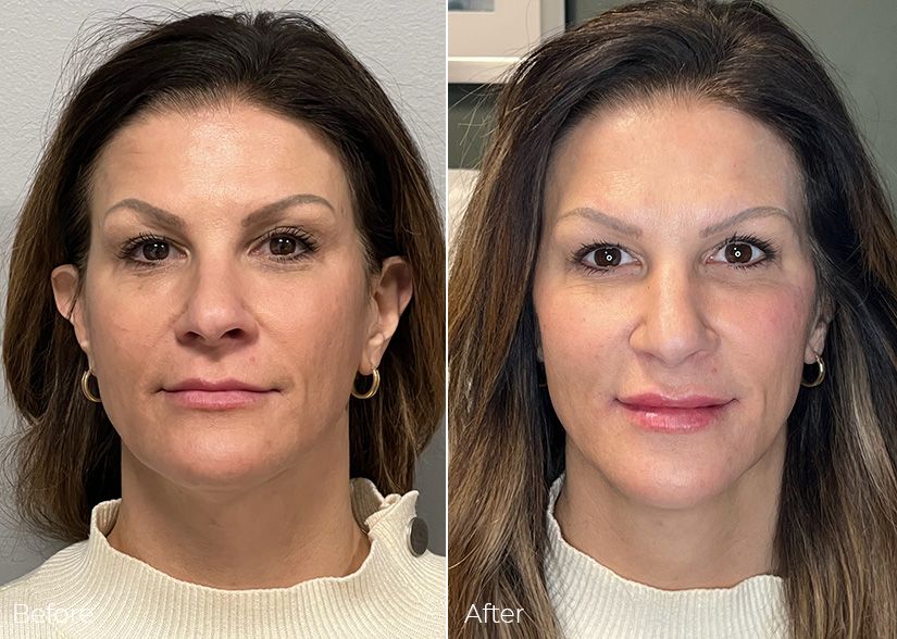 A before and after photo of a woman 's face.