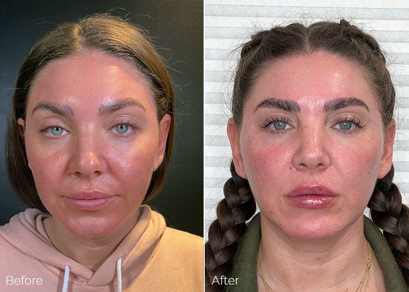 A before and after photo of a woman 's face.