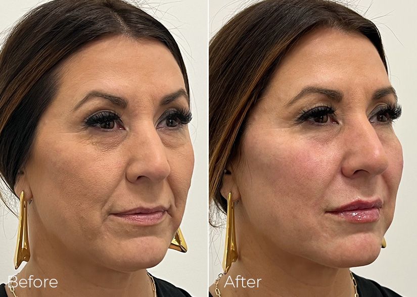 A before and after photo of a woman 's face.