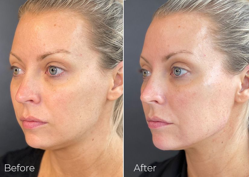 A before and after photo of a woman 's face.