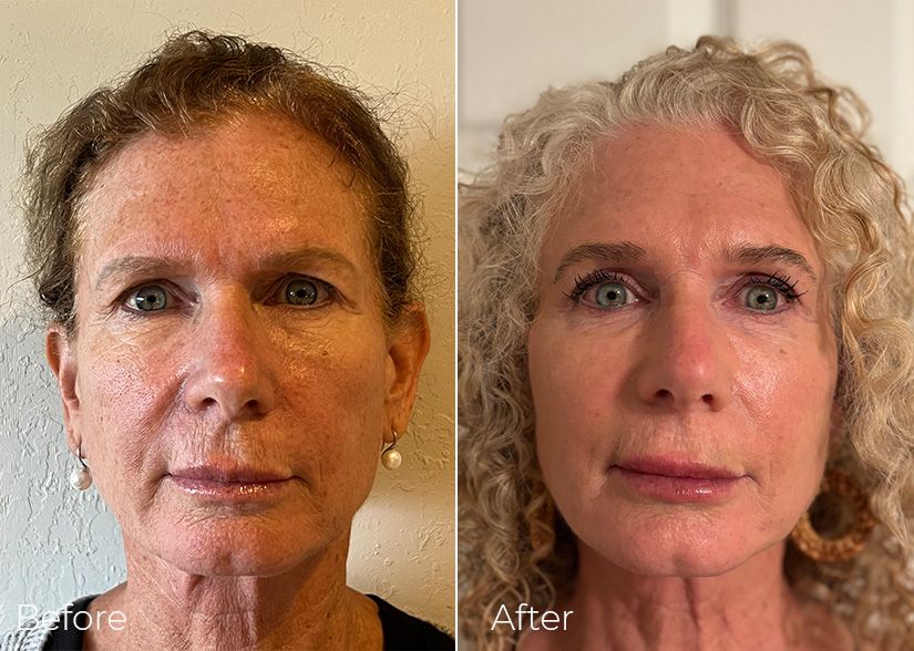 A before and after photo of a woman 's face.