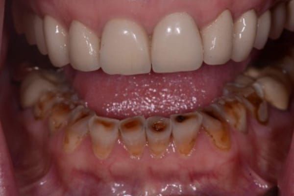 crowns, veneers, and full mouth reconstruction before