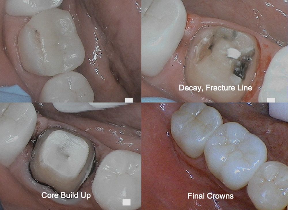 Core Build Up