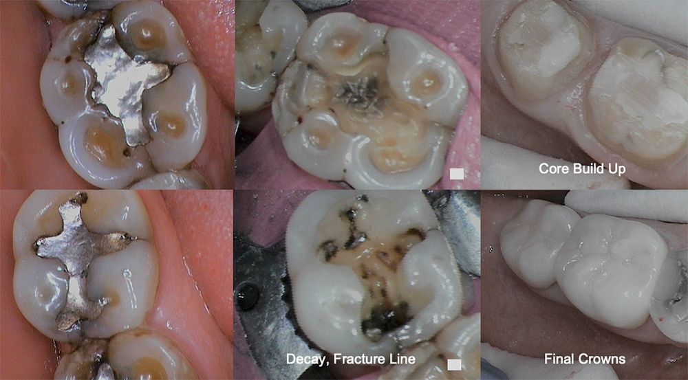 Crown Build Up