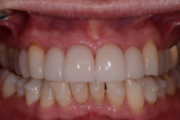 crowns, veneers, and full mouth reconstruction after