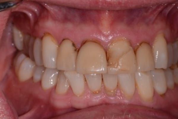 crowns, veneers, and full mouth reconstruction before
