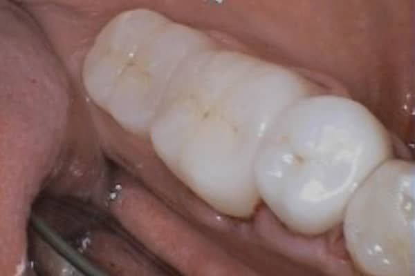 crowns, veneers, and full mouth reconstruction after