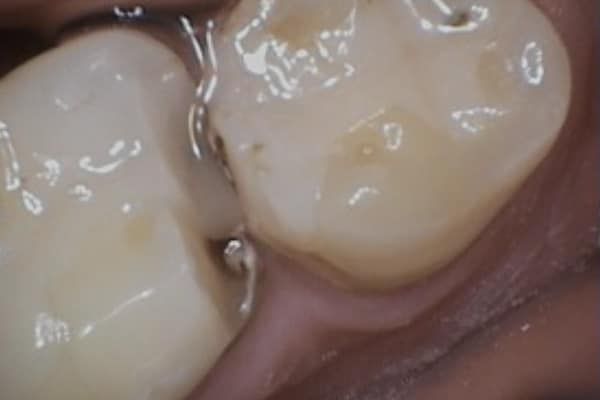 crowns, veneers, and full mouth reconstruction before