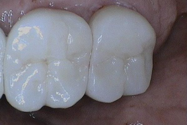 crowns, veneers, and full mouth reconstruction after