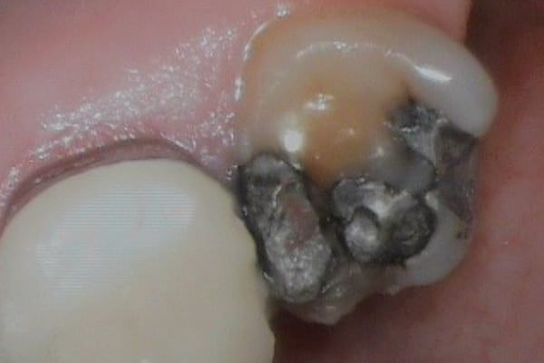 crowns, veneers, and full mouth reconstruction before