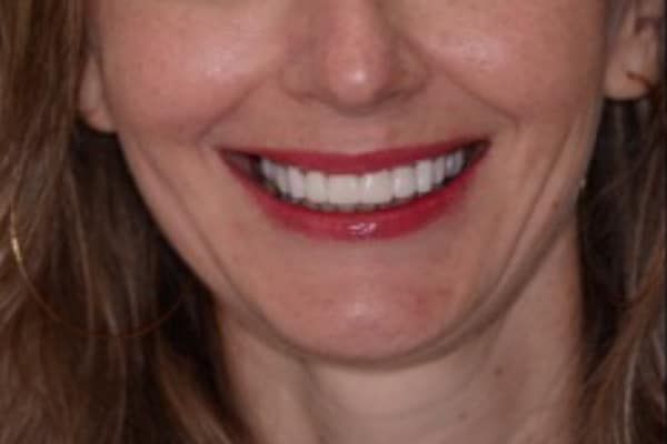 crowns, veneers, and full mouth reconstruction after