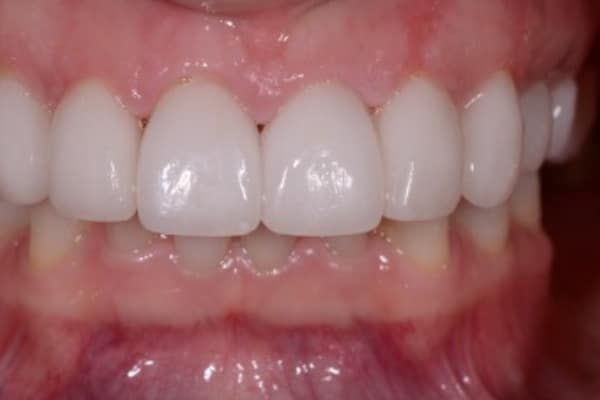 crowns, veneers, and full mouth reconstruction after