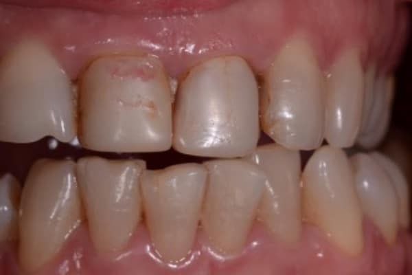 crowns, veneers, and full mouth reconstruction before