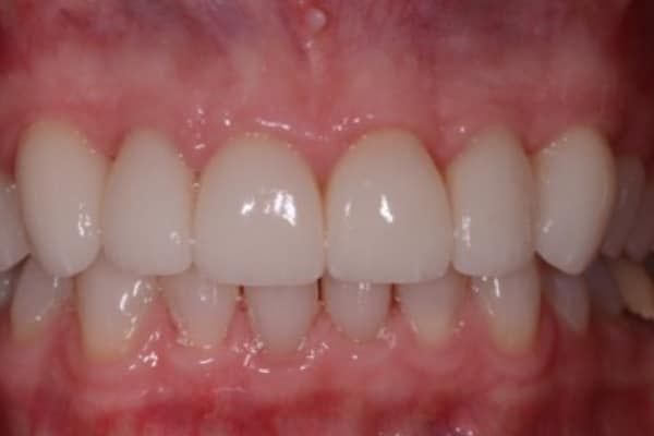 crowns, veneers, and full mouth reconstruction after