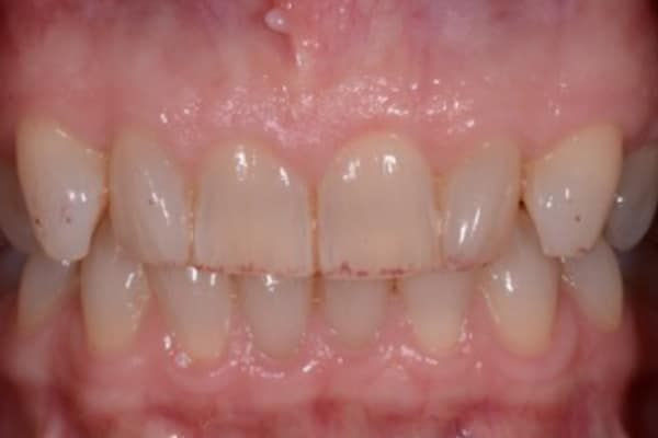 crowns, veneers, and full mouth reconstruction before
