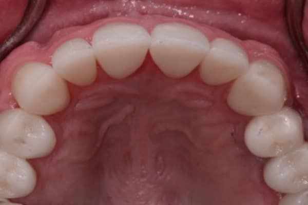 crowns, veneers, and full mouth reconstruction after