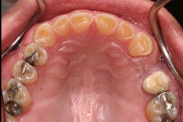 crowns, veneers, and full mouth reconstruction before
