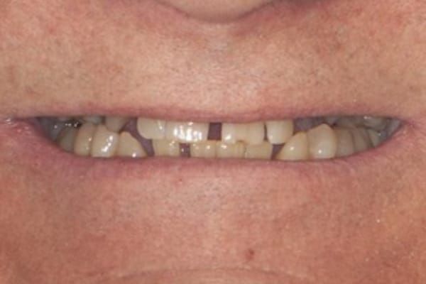 Dentures Before