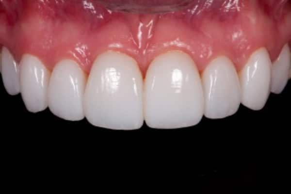 Veneers after